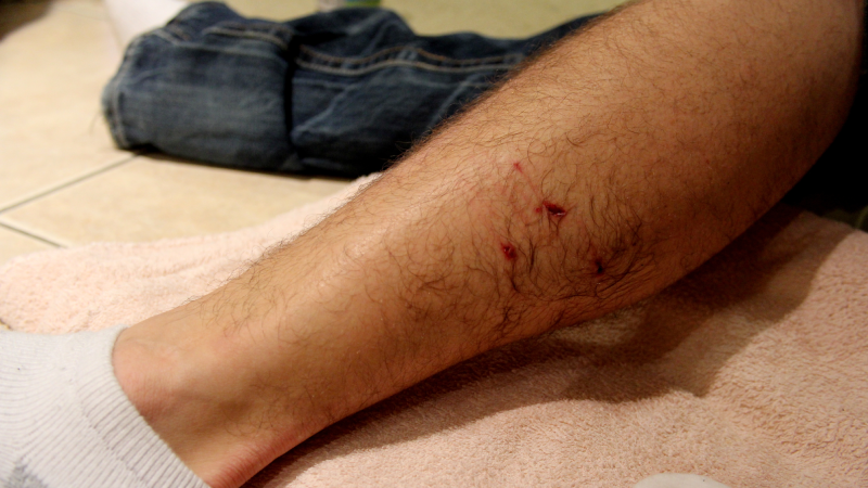 Dog Bite Wound 3